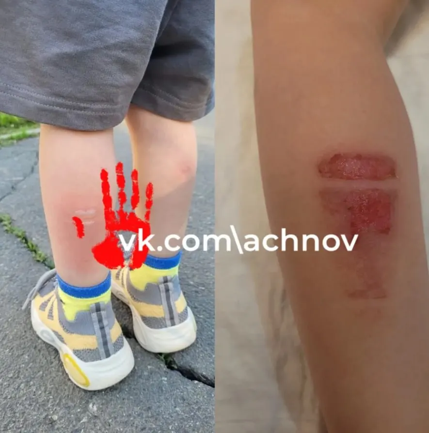 В автобусе №2 трёхлетний ребёнок получил ожог ноги после соприкосновения с радиатором. Следственные органы начали проверку и возбудили уголовное дело по статье об оказании небезопасных услуг.